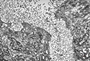 M,12y. | plexus papilloma M,12y. | plexus papilloma